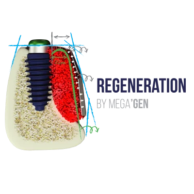 regeneration by megagen